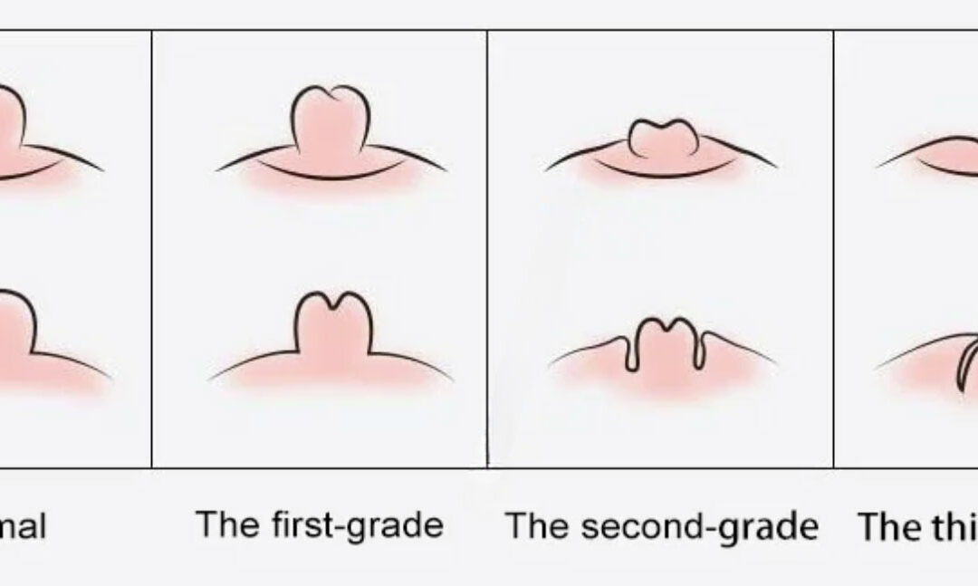 What are inverted nipples and how are they treated?